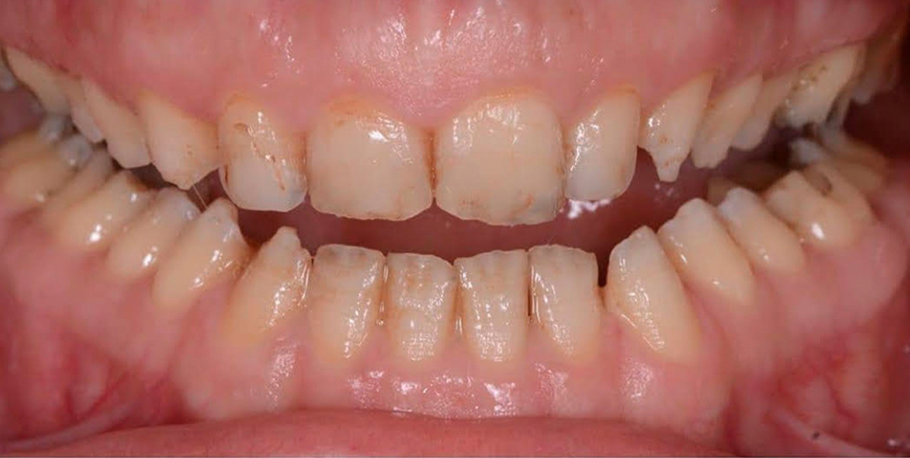 before treatment image